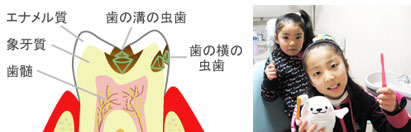 むし歯構造