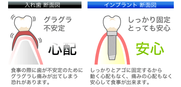インプラント断面図