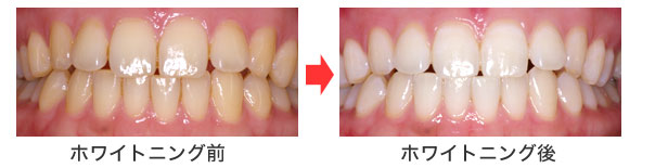ホワイトニング